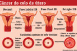 câncer de colo de útero sintomas e prevenção