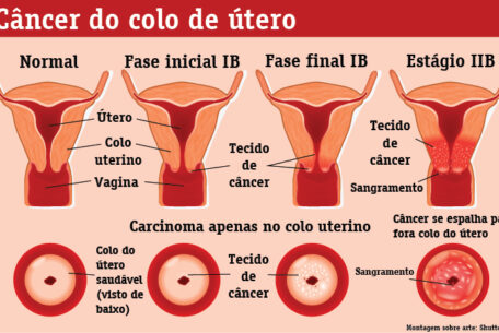 câncer de colo de útero sintomas e prevenção